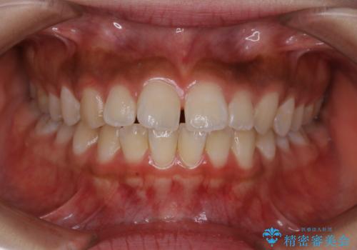 短期間ですきっ歯を改善:インビザラインLiteの治療前