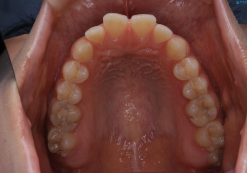 短期間ですきっ歯を改善:インビザラインLiteの治療前