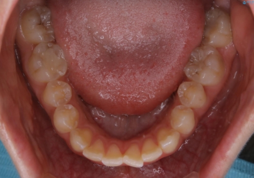 短期間ですきっ歯を改善:インビザラインLiteの治療前