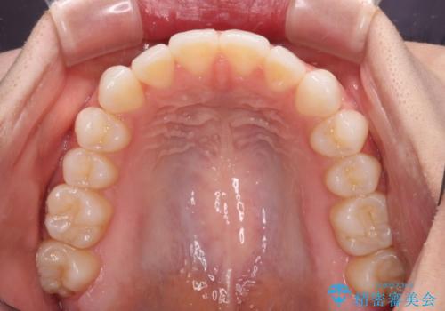 上下前歯が接触しない　オープンバイトをインビザラインで改善の治療中
