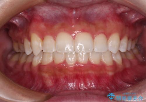八重歯を改善　目立たないワイヤー装置での矯正治療の症例 治療後