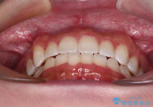 八重歯を改善 目立たないワイヤー装置での矯正治療の治療後