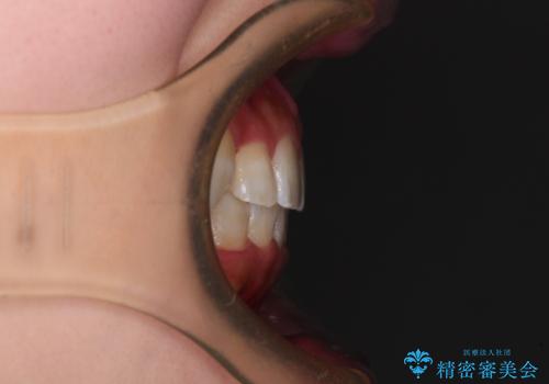 八重歯を改善 目立たないワイヤー装置での矯正治療の治療後