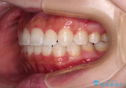 八重歯を改善　目立たないワイヤー装置での矯正治療の治療後