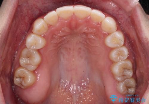 八重歯を改善 目立たないワイヤー装置での矯正治療の治療後