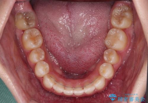 八重歯を改善 目立たないワイヤー装置での矯正治療の治療後