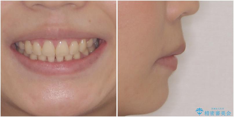 上顎前突 目立たないワイヤー装置での抜歯矯正の治療後(顔貌)