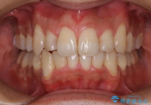 メンテナンスと一緒にクリーニング(PMTC)の症例 治療前