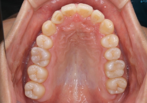 メンテナンスと一緒にクリーニング(PMTC)の治療前