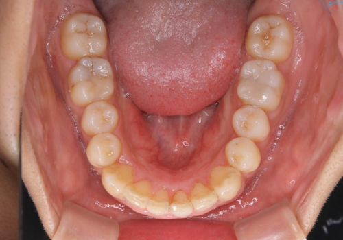 メンテナンスと一緒にクリーニング(PMTC)の治療前