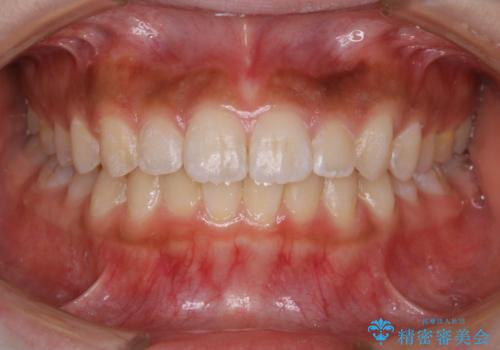 短期間ですきっ歯を改善:インビザラインLiteの治療中