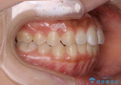 短期間ですきっ歯を改善:インビザラインLiteの治療中