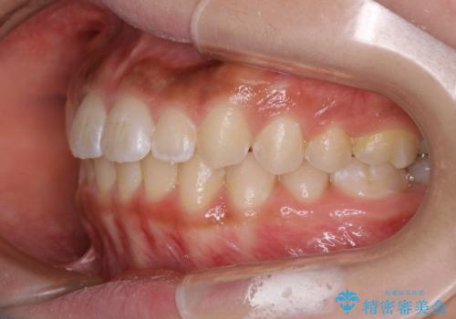短期間ですきっ歯を改善:インビザラインLiteの治療中
