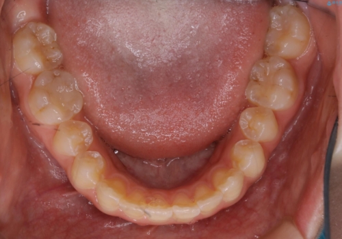 短期間ですきっ歯を改善:インビザラインLiteの治療中