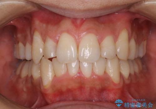 メンテナンスと一緒にクリーニング(PMTC)の症例 治療後