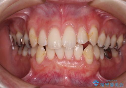 磨きすぎて傷が付くほどの歯根　歯肉移植術による根面被覆の治療後