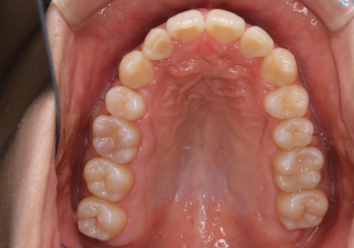 メンテナンスと一緒にクリーニング(PMTC)の治療後