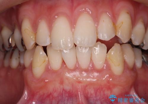 磨きすぎて傷が付くほどの歯根　歯肉移植術による根面被覆の治療後