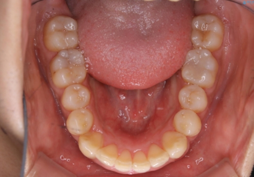 メンテナンスと一緒にクリーニング(PMTC)の治療後