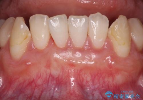 磨きすぎて傷が付くほどの歯根　歯肉移植術による根面被覆の症例 治療後