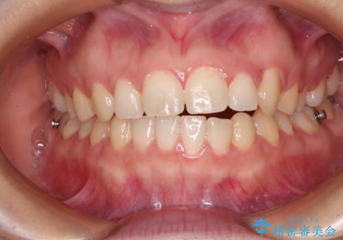 気になる残存乳歯と八重歯 ワイヤー矯正を併用したインビザライン治療の治療中