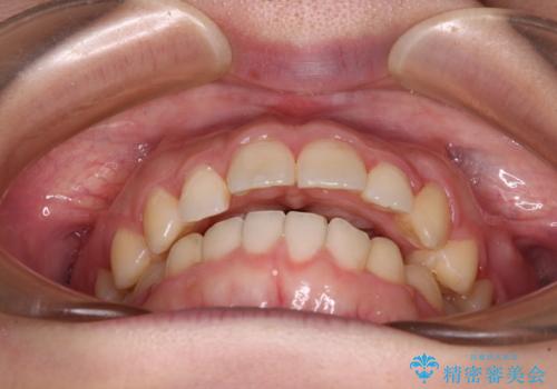 気になる残存乳歯と八重歯　ワイヤー矯正を併用したインビザライン治療の治療中