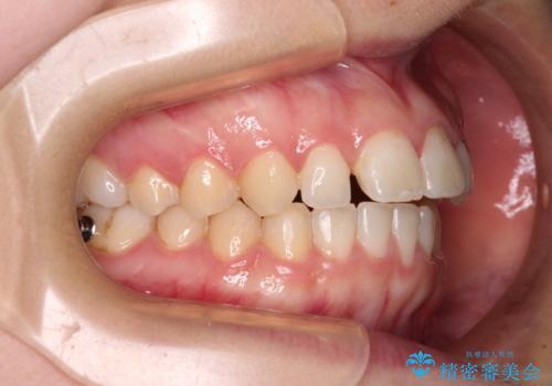 気になる残存乳歯と八重歯　ワイヤー矯正を併用したインビザライン治療の治療中