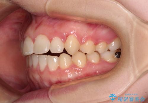 気になる残存乳歯と八重歯 ワイヤー矯正を併用したインビザライン治療の治療中