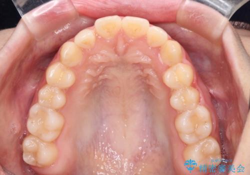 気になる残存乳歯と八重歯 ワイヤー矯正を併用したインビザライン治療の治療中