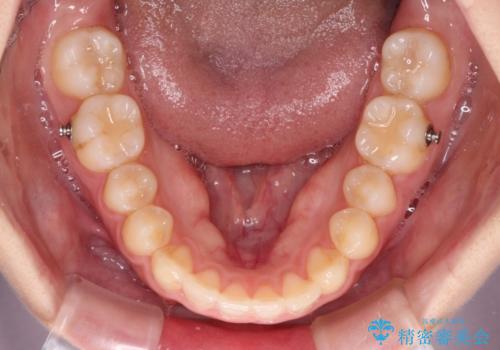 気になる残存乳歯と八重歯 ワイヤー矯正を併用したインビザライン治療の治療中