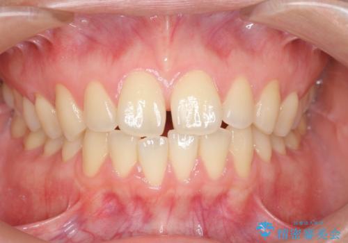[ マウスピース矯正で前歯の改善 ]  前歯のすきっ歯を治したいの治療前