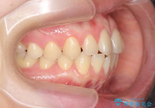 [ マウスピース矯正で前歯の改善 ]  前歯のすきっ歯を治したいの治療前
