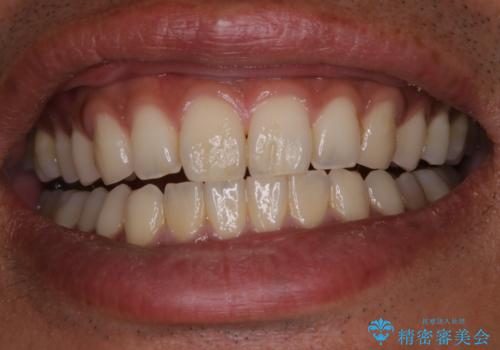 PMTCで清潔感のある明るい口元にの治療前