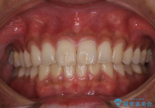PMTCで清潔感のある明るい口元にの治療前