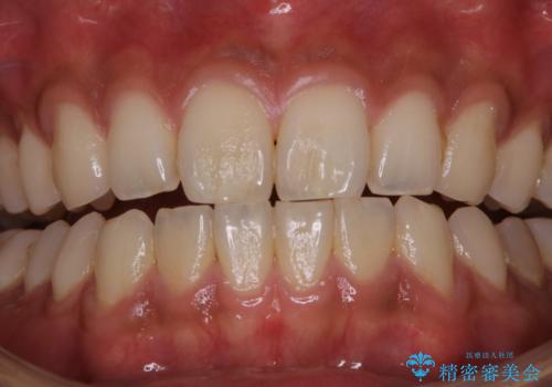 PMTCで清潔感のある明るい口元にの治療前