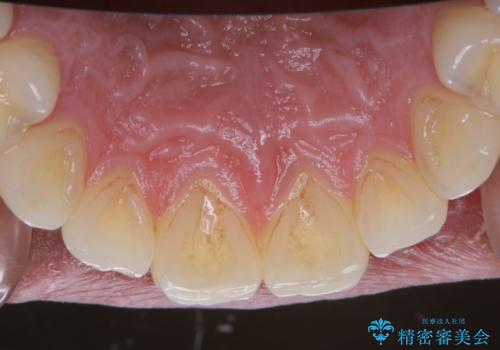 PMTCで清潔感のある明るい口元にの治療前