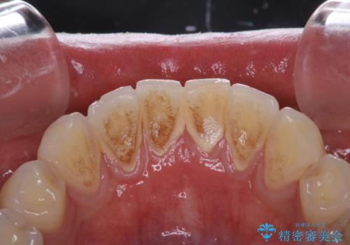 PMTCで清潔感のある明るい口元にの治療前