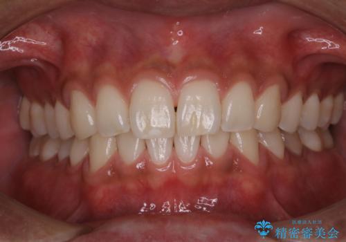 PMTCで清潔感のある明るい口元にの治療後