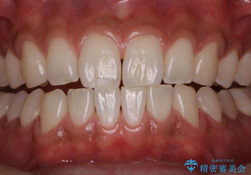 PMTCで清潔感のある明るい口元にの治療後