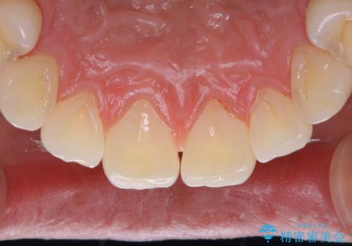 PMTCで清潔感のある明るい口元にの治療後