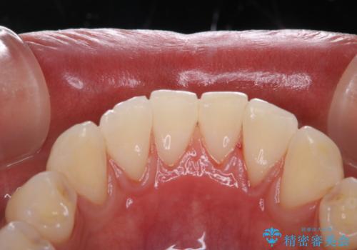PMTCで清潔感のある明るい口元にの治療後