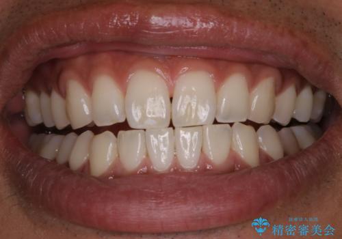 PMTCで清潔感のある明るい口元にの治療後