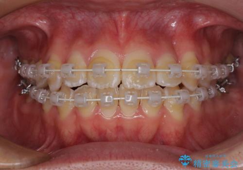 非抜歯ワイヤー装置による、短期間での矯正治療の治療中