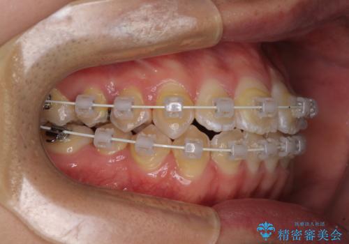 非抜歯ワイヤー装置による、短期間での矯正治療の治療中
