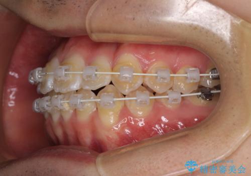 非抜歯ワイヤー装置による、短期間での矯正治療の治療中