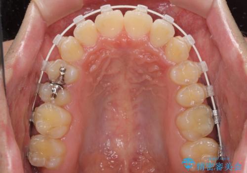 非抜歯ワイヤー装置による、短期間での矯正治療の治療中