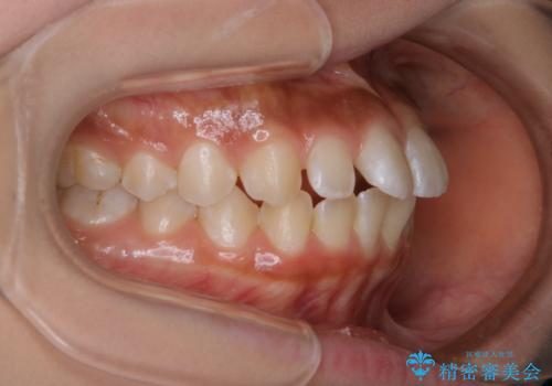短期間ですきっ歯を改善:インビザラインLiteの治療前