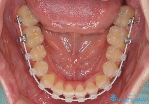 非抜歯ワイヤー装置による、短期間での矯正治療の治療中