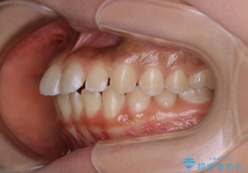 短期間ですきっ歯を改善:インビザラインLiteの治療前