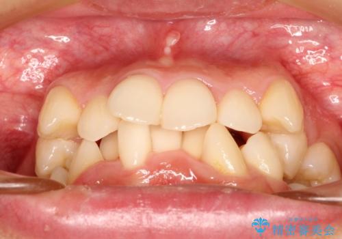【八重歯・重度のがたつきでお悩みの方必見】抜歯矯正症例(審美ワイヤー矯正)の治療前